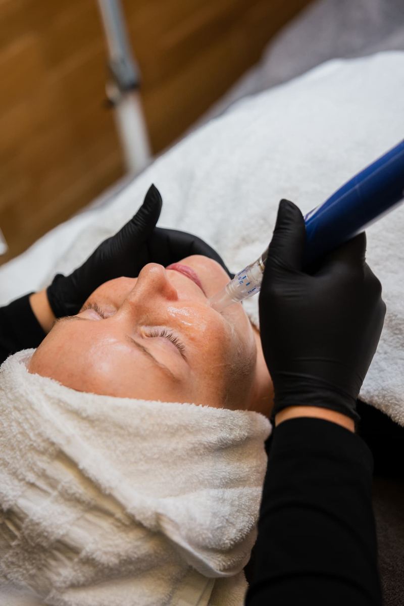 SkinPen Microneedling im Gesicht bei hautnah.kosmos